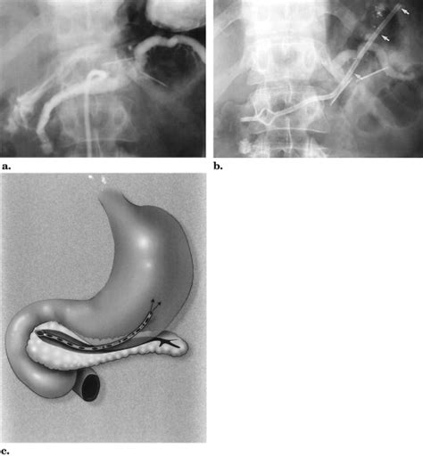 Percutaneous Management Of Chronic Pancreatic Duct Strictures And