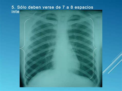 Torax normal en Imagenología PPT