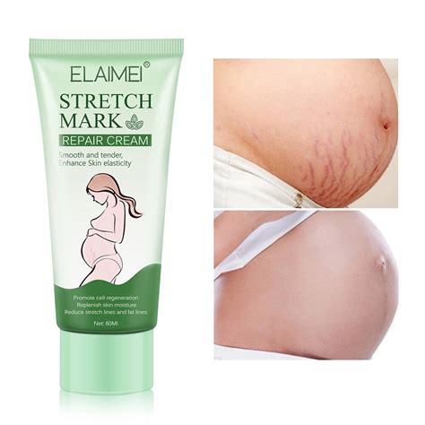 Stretch Mark Repair Cream Removes Postpartum Scar Treatment Lighten