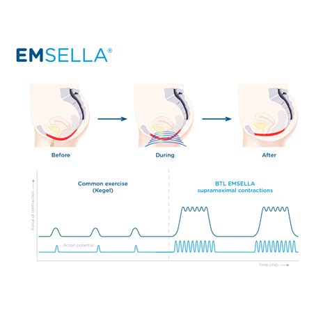 Emsella Hifem That Targets The Pelvic Floor Dr Yusra