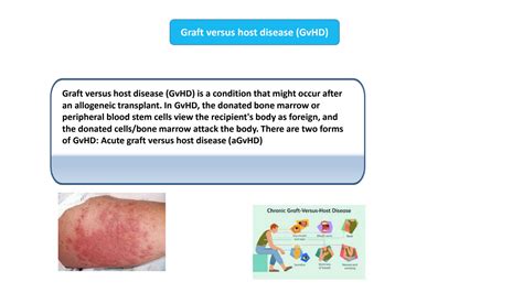 Solution Graft Versus Host Disease Gvhd Diagnosis And Treatments