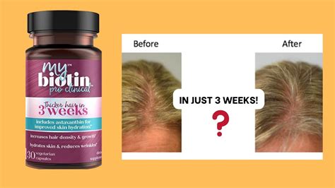 My Biotin Pro Clinical Dont Buy Until You Know This Youtube