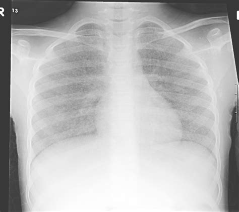 Chest X Ray Of Miliary Tuberculosis Download Scientific Diagram