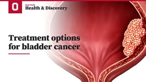 Treatment options for bladder cancer | Ohio State Medical Center - YouTube