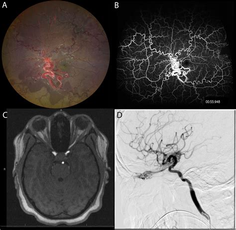 Retinal And Intracranial Arteriovenous Malformations In Wyburnmason Syndrome Canadian Journal