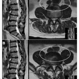 Preoperative T Weighted Magnetic Resonance Imaging Mri Sequence