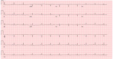 Pericardial Effusion Ecg