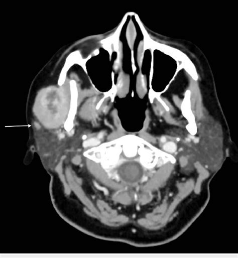 Preoperative neck CT scan A neck CT scan showed a well-circumscribed... | Download Scientific ...