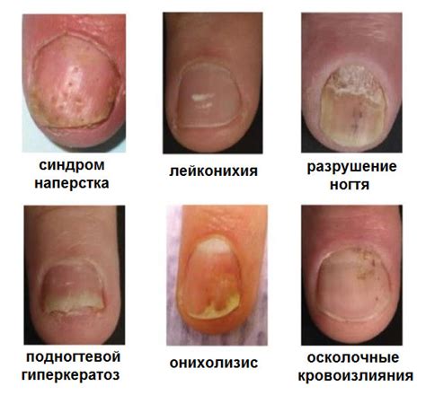 Псориаз ногтей: что это, причины, симптомы и методы лечения