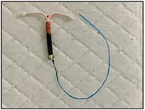 Retrieved Copper T IUD. | Download Scientific Diagram