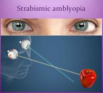 Strabismus and amblyopia: Standard Treatment Guidelines