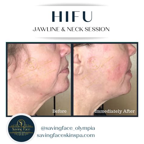 Hifu Subcutaneous Tissue Facial Before And After Skin Tightening Surgery