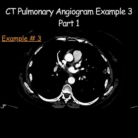 Ct Pulmonary Angiogram Example 3 Part 1 Radiologist Radiology