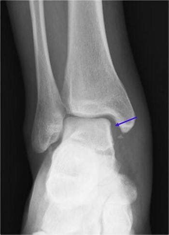 Twists And Turns Identifying Maisonneuve Fractures In The Ed Taming