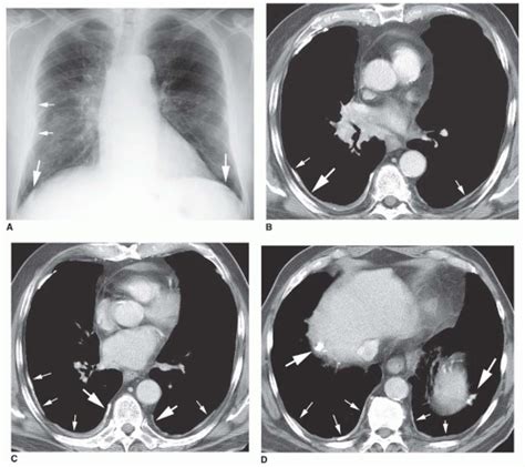 The Pleura And Pleural Disease Radiology Key