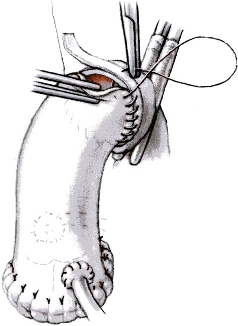 Aortic Root | Dr Krasopoulos