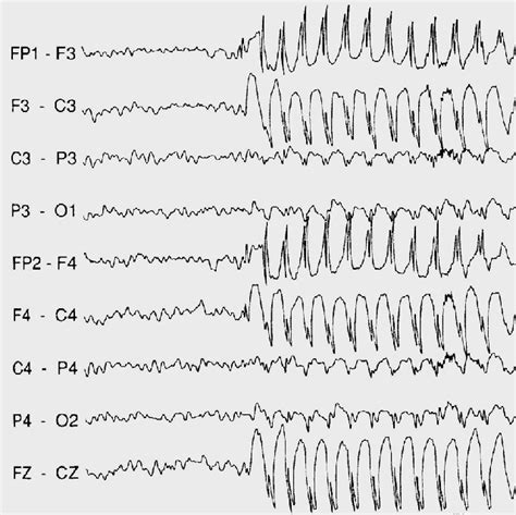 Abnormal Eeg Spikes