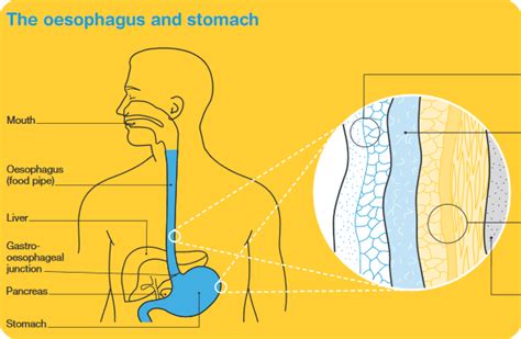 Final Stages Of Esophageal Cancer What To Expect - CancerWalls