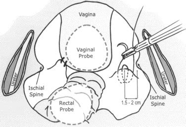 Laparoscopic Vaginal Vault Suspension Using Uterosacral Ligaments A