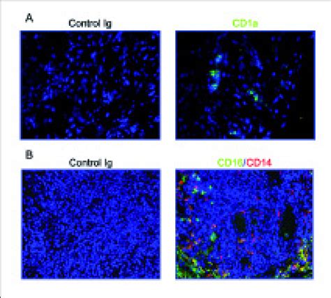 Expression Of Two Mdc Subsets In Ra Synovial Tissue Immunofluorescence