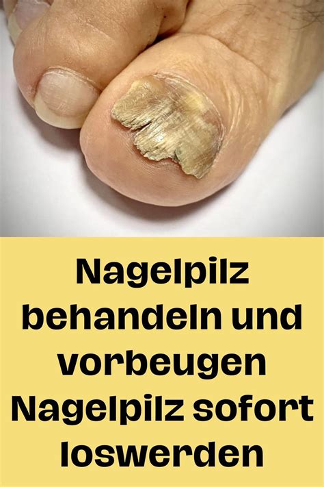 Nagelpilz Behandeln Und Vorbeugen Nagelpilz Sofort Loswerden Womens