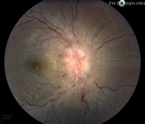 Atlas Entry Idiopathic Intracranial Hypertension Iih
