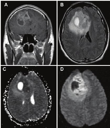 Mri Of Glioblastoma With Pnet Like Components A Coronal T Weighted