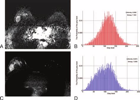 Axial Magnetic Resonance Images Show An Example Of Texture Analysis In