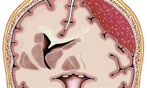 Decompressive Craniectomy Versus Craniotomy For Acute Subdural Hematoma