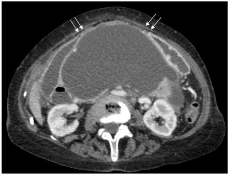 Pancreatic Pseudocyst Ultrasound