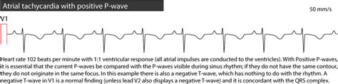 Ectopic Atrial Rhythm Eat Atrial Tachycardia At And Multifocal Atrial Tachycardia Mat