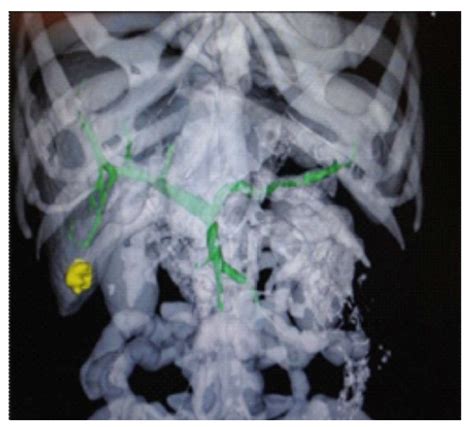 Scielo Brasil The Introduction Of Navigation In Liver Surgery In