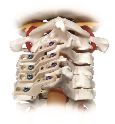 Relieve™ Radiolucent Laminoplasty System Globus Medical