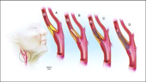 Treatment Of Carotid Artery Stenosis Medical Therapy Surgery Or