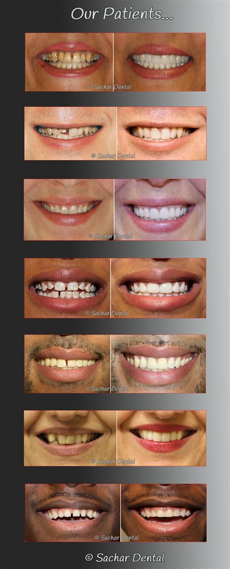 Smile Makeover Nyc By Dr Sachar