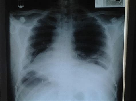 Preoperative Plain Chest Radiograph Showing Dextrocardia Air Under The