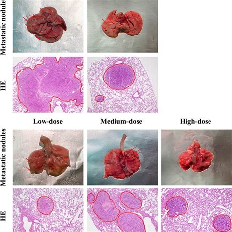 Lung Metastatic Nodules Naked Eyes And Histopathological Changes Of