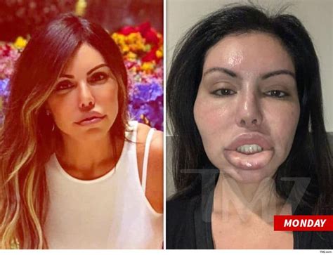 Liziane Gutierrez's Plastic Surgery Nightmare is Getting Worse