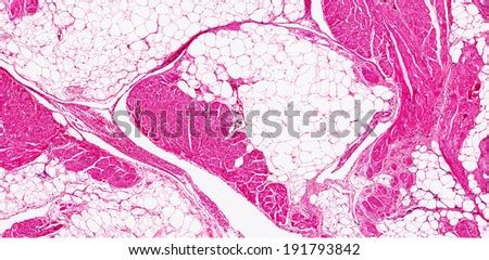 Fat Infiltration Of The Heart Fatty Infiltration Of The Myocardium