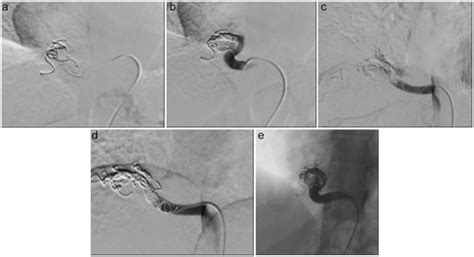 Successful Endovascular Embolization Of An Intralobar Pulmonary