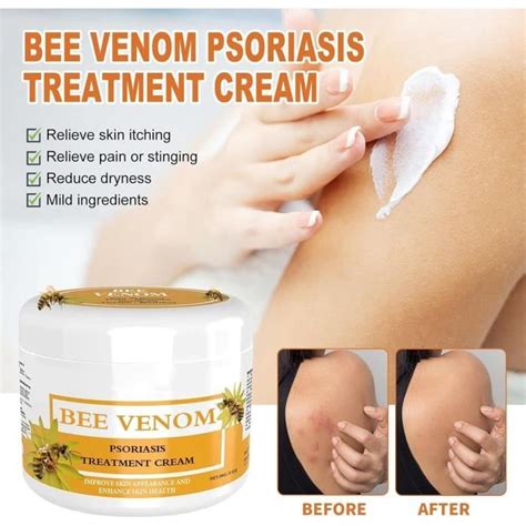 Cr Me Contre Le Psoriasis Au Venin D Abeille Cr Me Contre Le Psoriasis