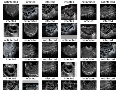 A Detailed Guide On Building PCOS Detection Model For ML Experts