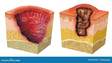 Ulceration stock illustration. Illustration of treatment - 30165767