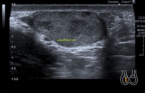 Testículos Ecografía Fácil