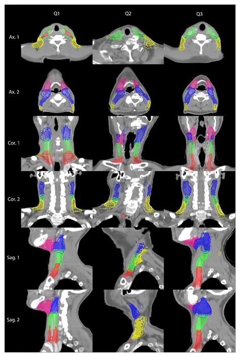 Cancers Free Full Text Deep Learning For Automated Elective Lymph