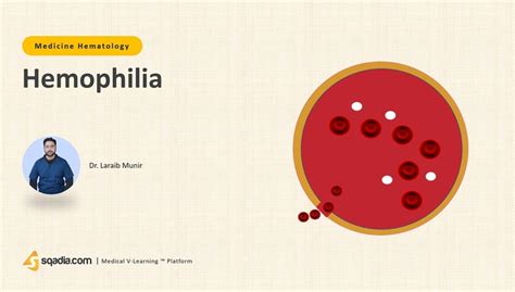 Hemophilia Medicine Hematology Medical Lecture Sqadia