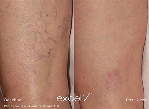 Spider Vein Treatment Lafayette Laser Vein Treatment Lafayette