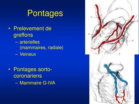 PPT La Chirurgie Cardiovasculaire PowerPoint Presentation Free