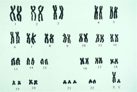 Types of Trisomy: Causes and Symptoms