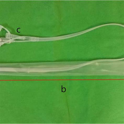 Insertion Of The Fecal Diversion Device Download Scientific Diagram